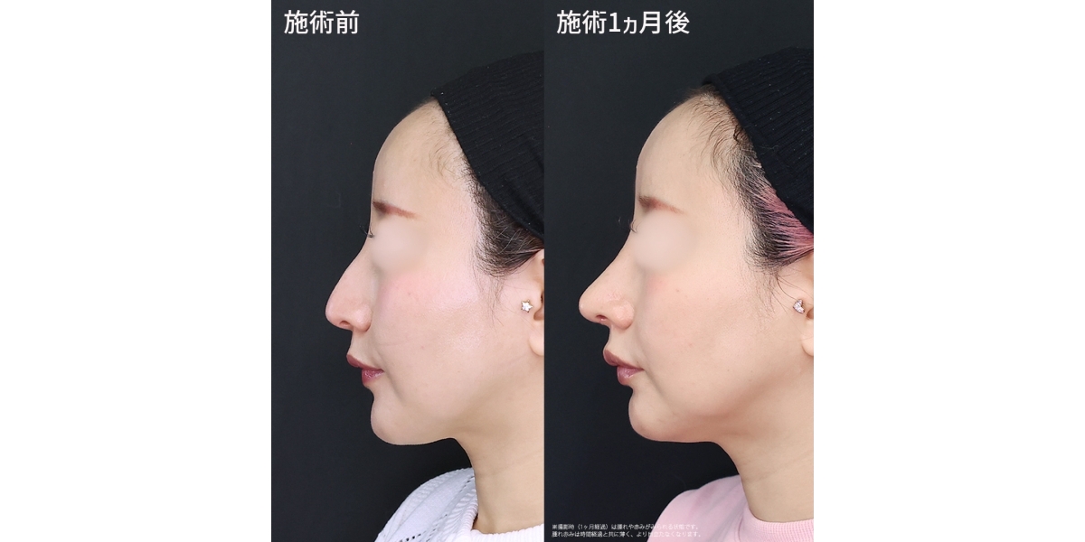 【他院修正】より洗練されたデザインの鼻整形｜症例写真・ビフォーアフター｜美容整形･美容外科のTAクリニックグループ