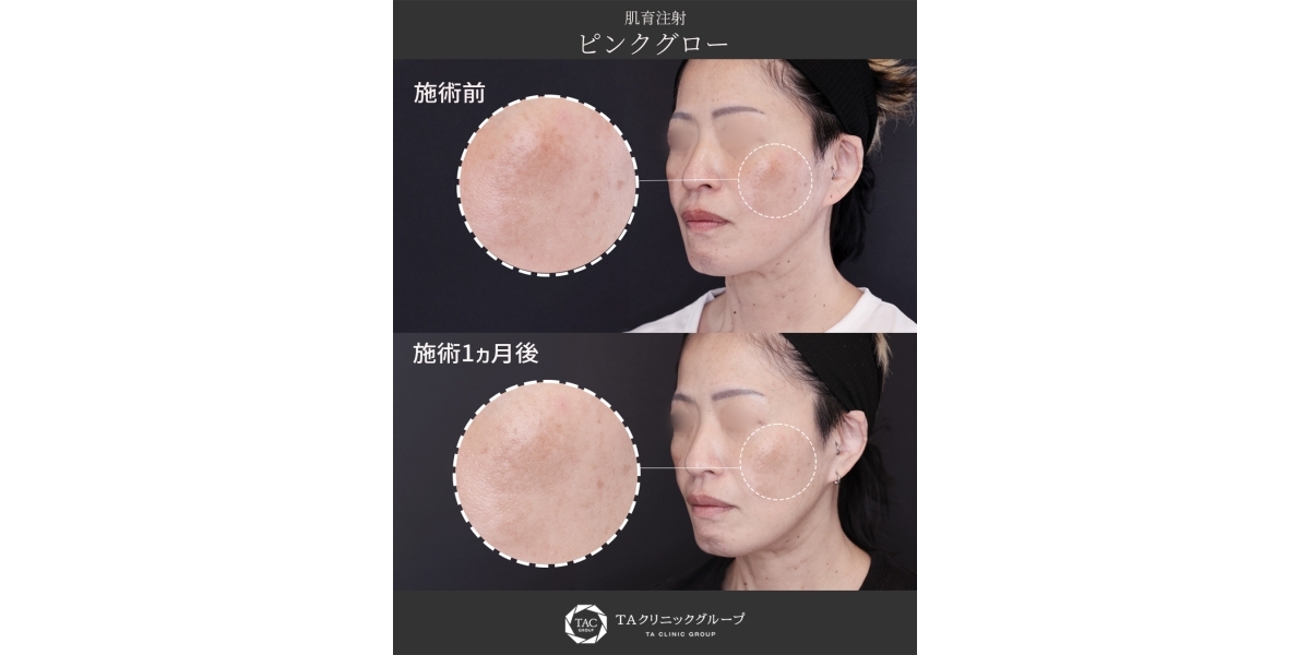 ピンクグロー】シミ・肝斑・色素沈着に効果的な肌育注射 ｜症例写真