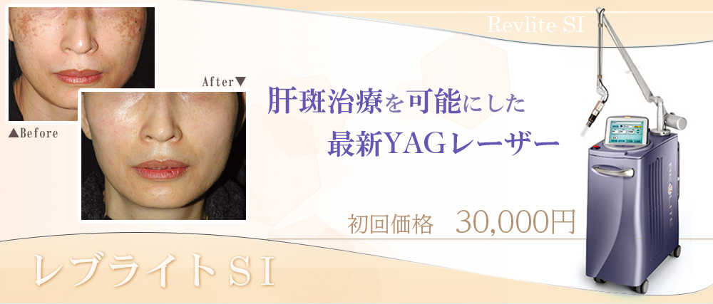 肝斑治療はレブライトSI