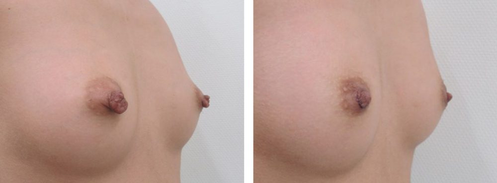 乳頭縮小術で乳頭の改善