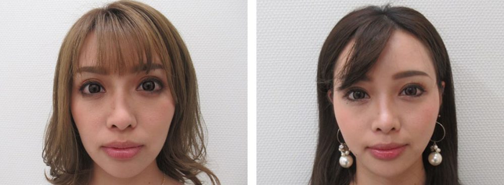 顎先にかけて綺麗なフェイスライン