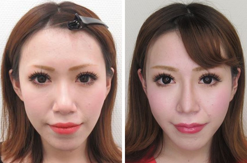 トータルビューティーモニター様の１ヵ月経過