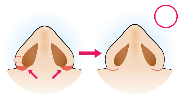 鼻翼の肉の厚みが薄い方(内側法)