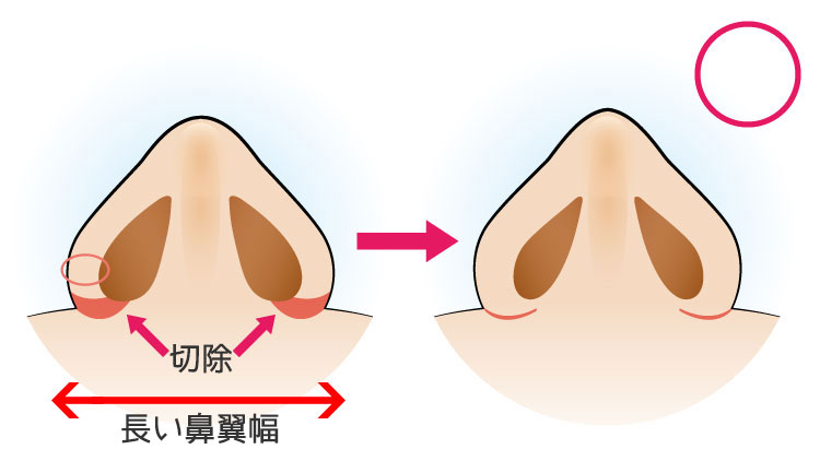 鼻翼の肉の厚みが薄い方(内側法)