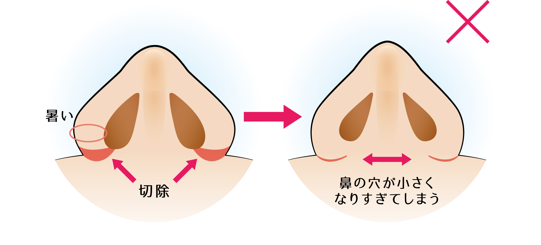 鼻翼の肉の厚みが厚い方(内側法+外側法)