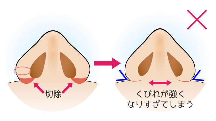 鼻翼の肉の厚みが厚い方(内側法+外側法)