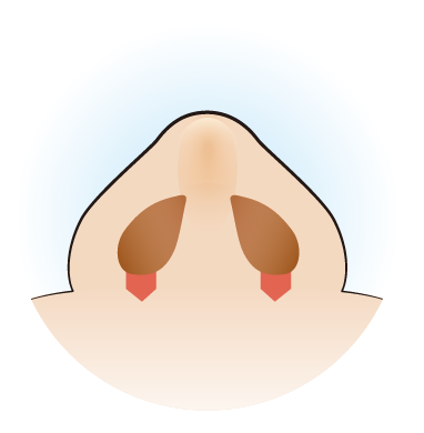 鼻翼挙上術内側法