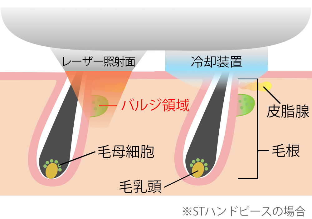 メディオスターNeXTPROの冷却装置で火傷を防ぐ