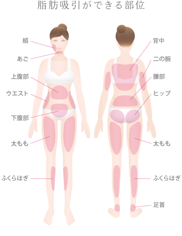 脂肪吸引ができる部位