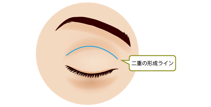 上眼瞼切開術 二重の形成ライン