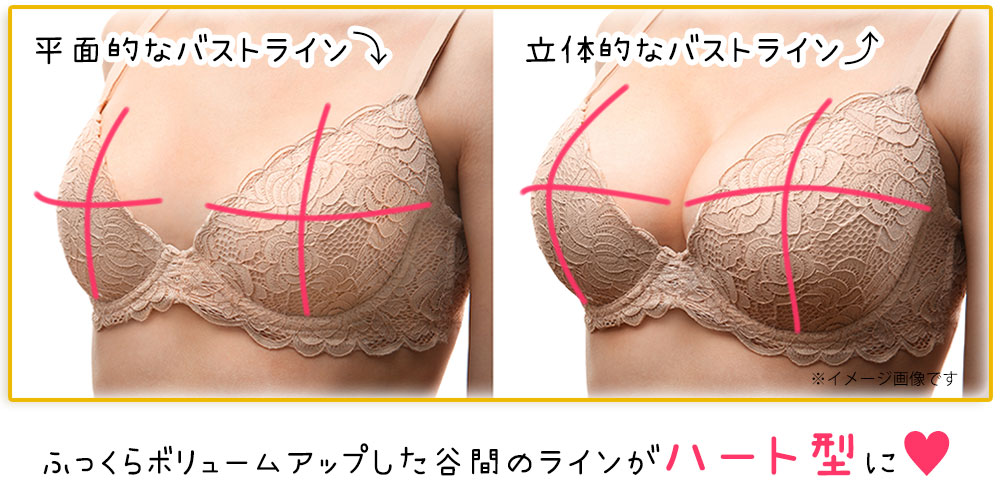 超音波(エコー)を使用してハートラインを描く立体的なバストへ豊胸術を行います